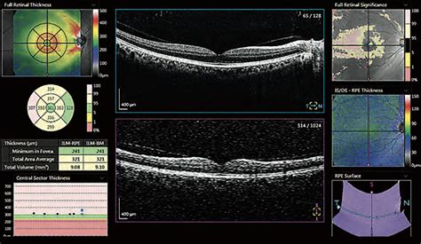 thickness measurement of retinal layers|retinal thickness problems.